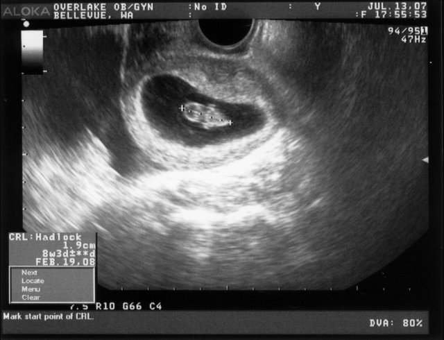 At 8 weeks: 1.9 cm [Ultrasound1.JPG]