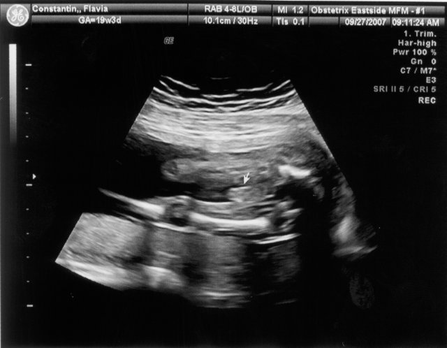 It's a boy! [Ultrasound9.jpg]